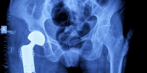 Fracture du col du femur : la prothese comme solution