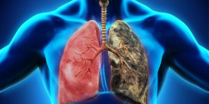 Traitement du cancer du poumon : les therapies ciblees