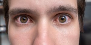 Blanc des yeux rouge : la conjonctivite allergique