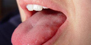 Ronflement : Votre langue est-elle trop grosse ?