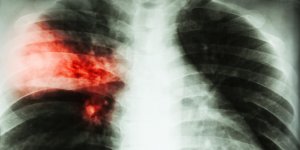 Cancer bronchique : quels sont les signes ?