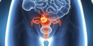 Traitement du cancer de l-uterus : quand recourir a l-hysterectomie ?