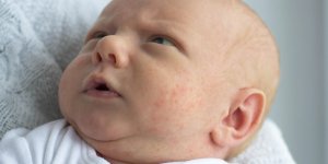 Petits boutons rouges sur le visage de bebe : 3 causes