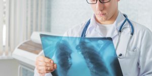 Stades du cancer du poumon : la classification TNM