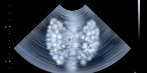 Thyroide : qu-est-ce qu-un nodule polaire ?