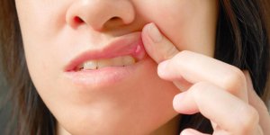 Bouton dans la bouche : aphte ou herpes, la difference