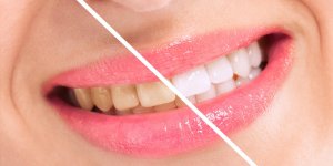 Produits pour blanchir les dents : les dentifrices blancheur