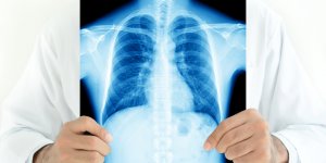 Cancer du poumon : les details du depistage