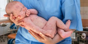 Varicelle chez bebe : les etapes de son evolution