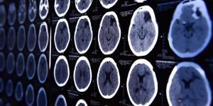 L’accumulation de lipides dans le cerveau pourrait etre un signe precoce de Parkinson