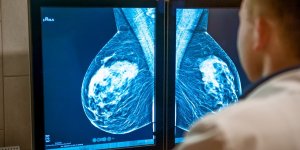 Cancer du sein : cette nouvelle technique de lecture des mammographies qui ameliore le depistage