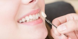 Protheses dentaires fixes : peuvent-elles tomber ?