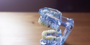 Tartre dentaire : les personnes les plus a risque