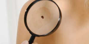 Boutons : un symptome de cancer de la peau ?