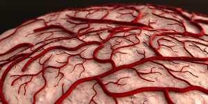 Thromboses cerebrales : les principales sequelles