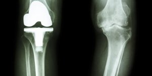 Prothese du genou : 3 complications a connaitre