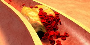 Arteriosclerose ou atherosclerose : quelle difference ?