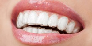 Gouttiere dentaire : le blanchiment ambulatoire