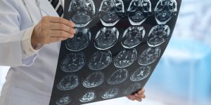 Tumeurs au cerveau : les cas inoperables