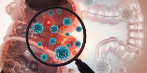 Cancer colorectal precoce : le microbiote intestinal en cause ?