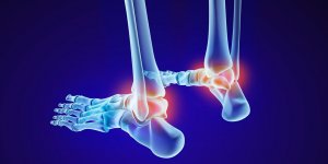 Orteil deforme : un symptome d-arthrose du pied