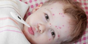 Sante de bebe : le virus de la varicelle