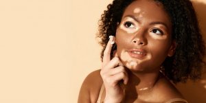 Vitiligo : premier traitement pour la repigmentation de la peau