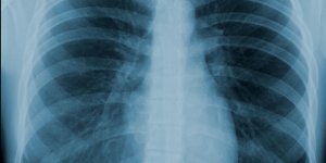 Metastase pulmonaire : les signes