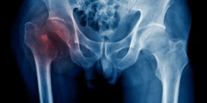 Fracture de la hanche : des habitudes simples peuvent reduire les risques