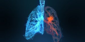 Cancer du poumon : 5 symptomes observes dans 70% des cas