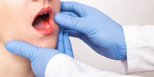 Cancer de la bouche : les 5 signes avant-coureurs a observer au quotidien
