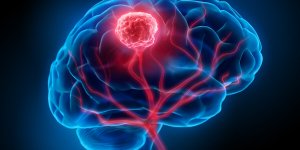 Tumeur cerebrale : 7 signes avant-coureurs que vous devez connaitre