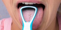 Langue blanche (langue saburrale) et bouche pâteuse : quelles causes ?