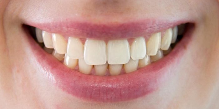 Comment stopper l’érosion dentaire