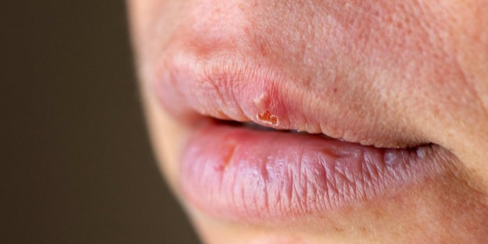 herpes on the lip close up macro