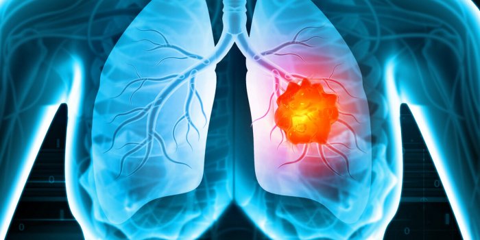 Cancer du poumon : bientôt un test urinaire pour le détecter ?