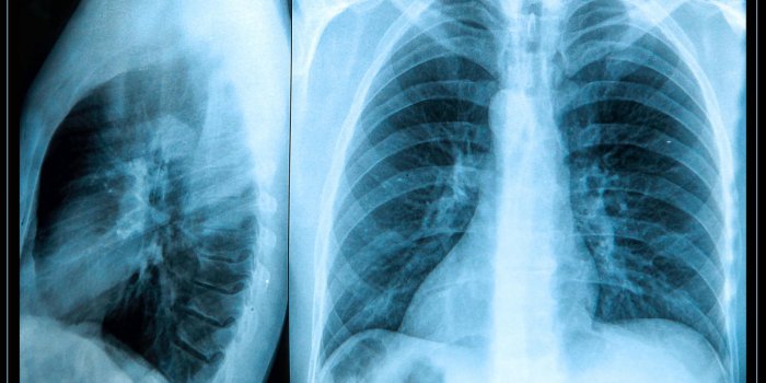 x-ray image of the human chest