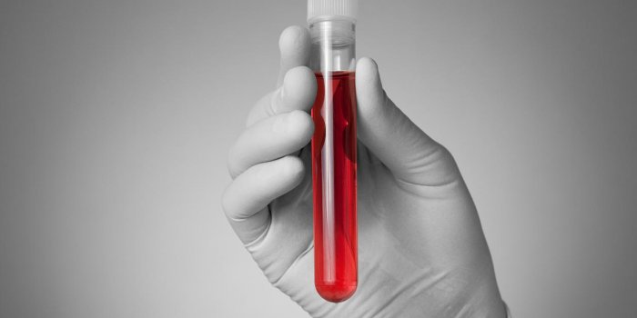 doctor holding a bottle of blood sample