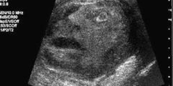 Un visage humain découvert sur la radiographie d'un testicule