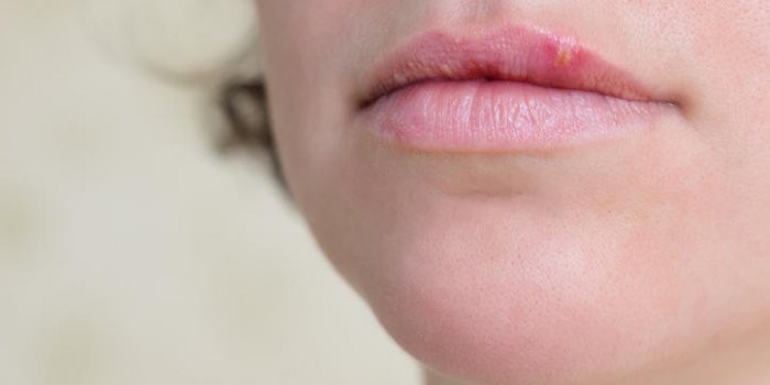 gros plan des lèvres féminines souffrant d'herpès