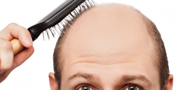 alopécie humaine ou perte de cheveux - main de l'homme adulte tenant peigne sur la tête chauve
