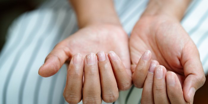 Mélanome : ces signes sur vos ongles peuvent l’annoncer