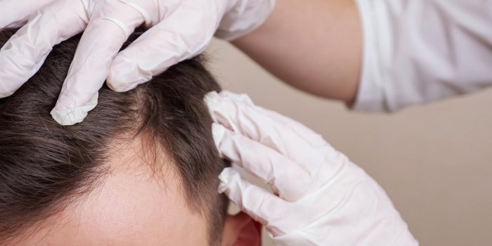 Perte de cheveux : avez-vous pensé à la greffe capillaire ?