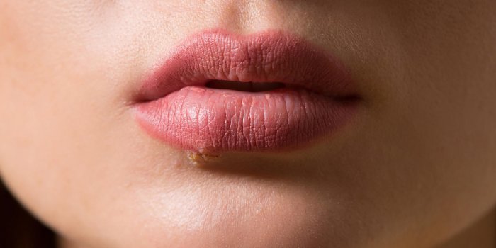 Aphte à la lèvre : comment le soigner ?