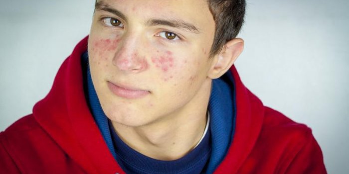 portrait d'un adolescent avec l'acné visage sérieux
