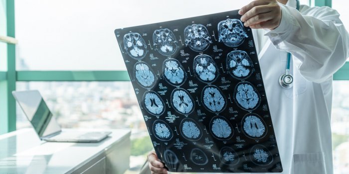 La maladie d’Alzheimer pourrait être transmissible d’après une étude