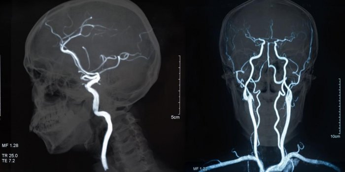 Anévrisme cérébral : comment se passe l'opération
