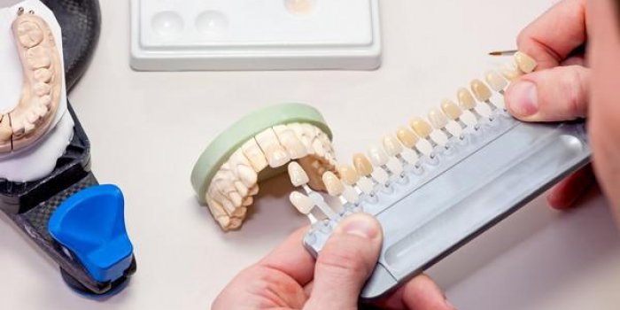 Les protheses dentaires fixes sur implants