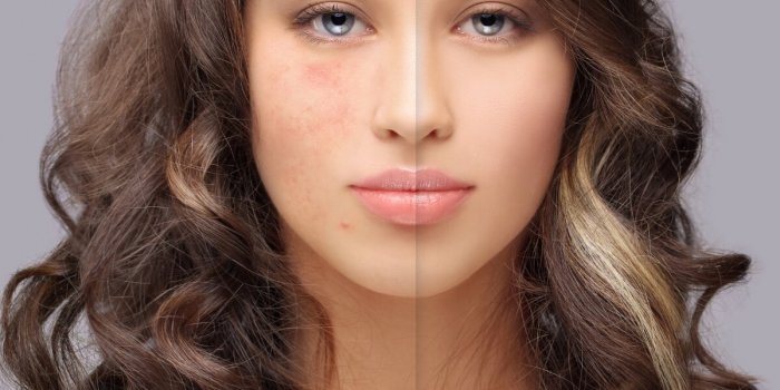 Top 3 des sérums qui feront disparaître votre acné