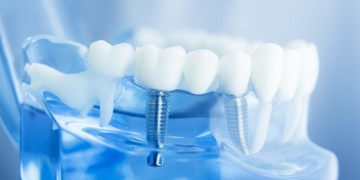 Prothèses dentaires : 7 complications que vous risquez si vous en portez une